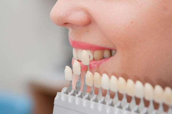 Cosmetic dentistry, Porcelain Veneers