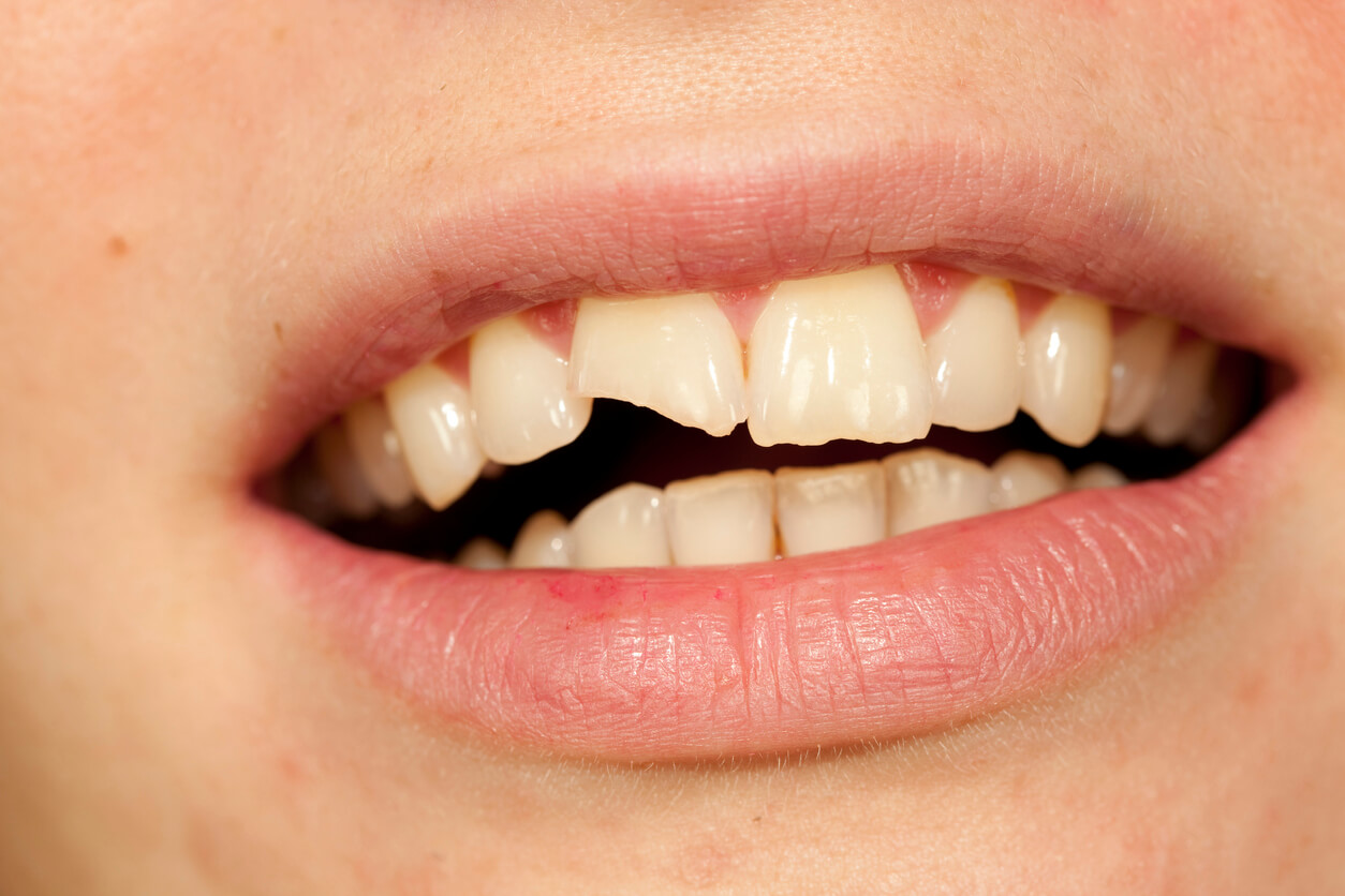 Broken teeth ACC treatment Auckland