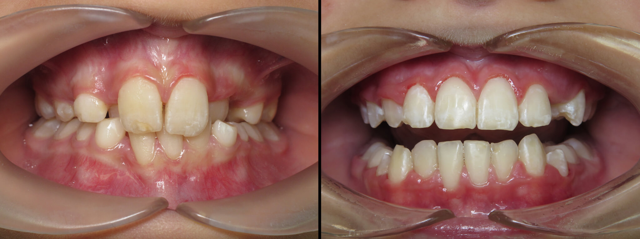 Orthodontics for Kids Fraser Dental, Hobsonville, Auckland