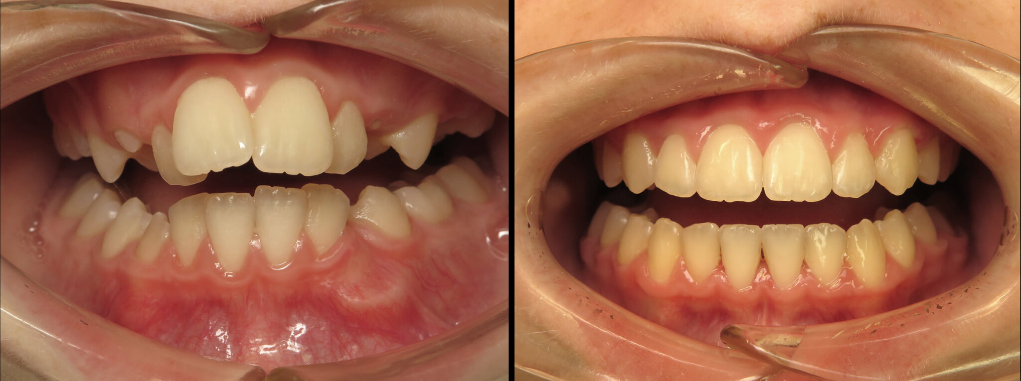 Orthodontics for Kids Fraser Dental, Hobsonville, Auckland