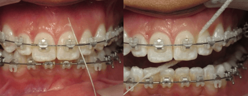 Flossing with braces