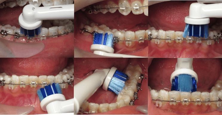 Brushing with braces