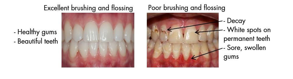 Before and after brushing with braces