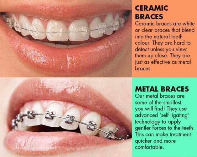 Orthodontics for teens, ceramic and metal braces