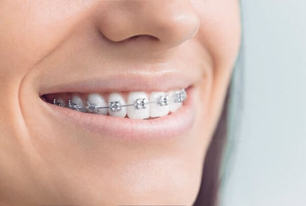 Orthodontics During COVID-19, braces, smiling