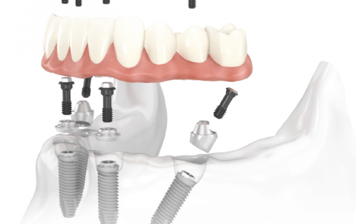 Are dental implants painful, diagram of dental implants