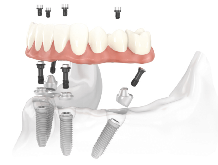 Are dental implants painful, diagram of dental implants