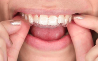 DIY teeth straightening, DIY clear aligners
