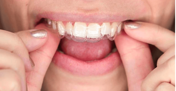 DIY teeth straightening, DIY clear aligners