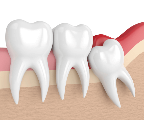 Wisdom teeth FAQs, cartoon wisdom tooth