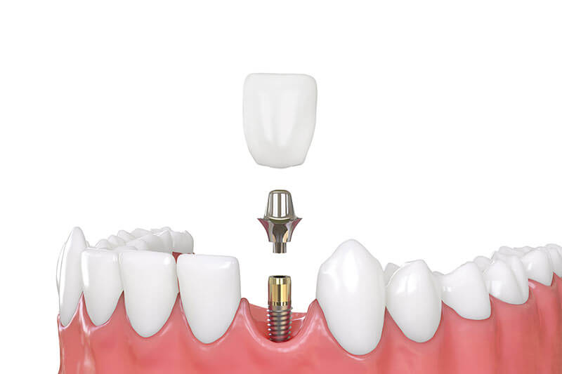 Dental implants versus bridges, tooth implant