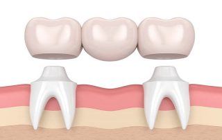 Dental implants versus bridges, dental bridges, tooth bridge