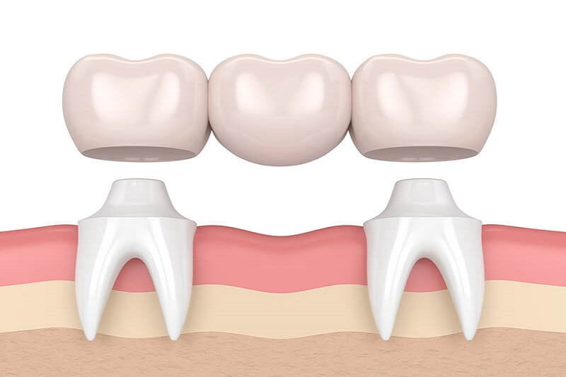 Dental implants versus bridges, dental bridges, tooth bridge