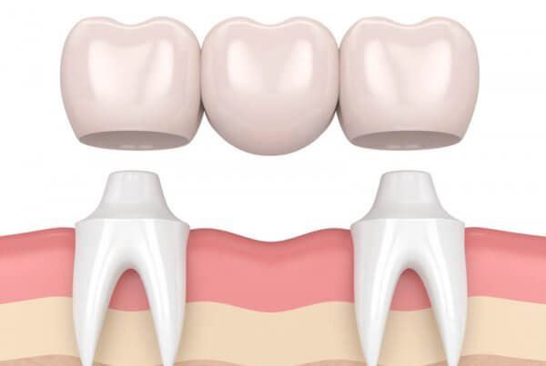 Dental implants versus bridges, dental bridges, tooth bridge