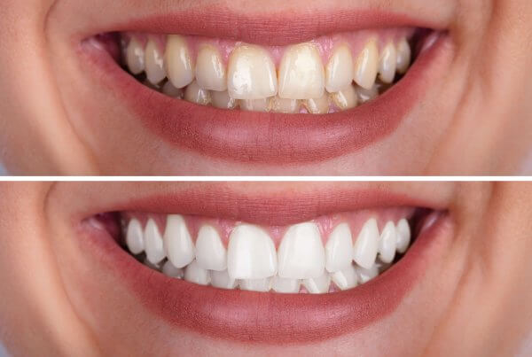 how long does teeth whitening last