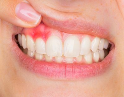 Gingivitis, red gums, gum disease