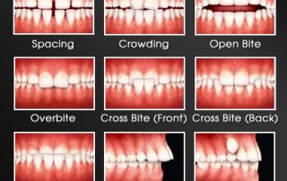 when to get an orthodontic consult, signs of crooked teeth, orthodontic problems