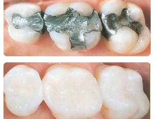 Replace Silver Fillings