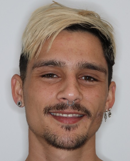 Finalist Ryan resized Smile Makeover competition