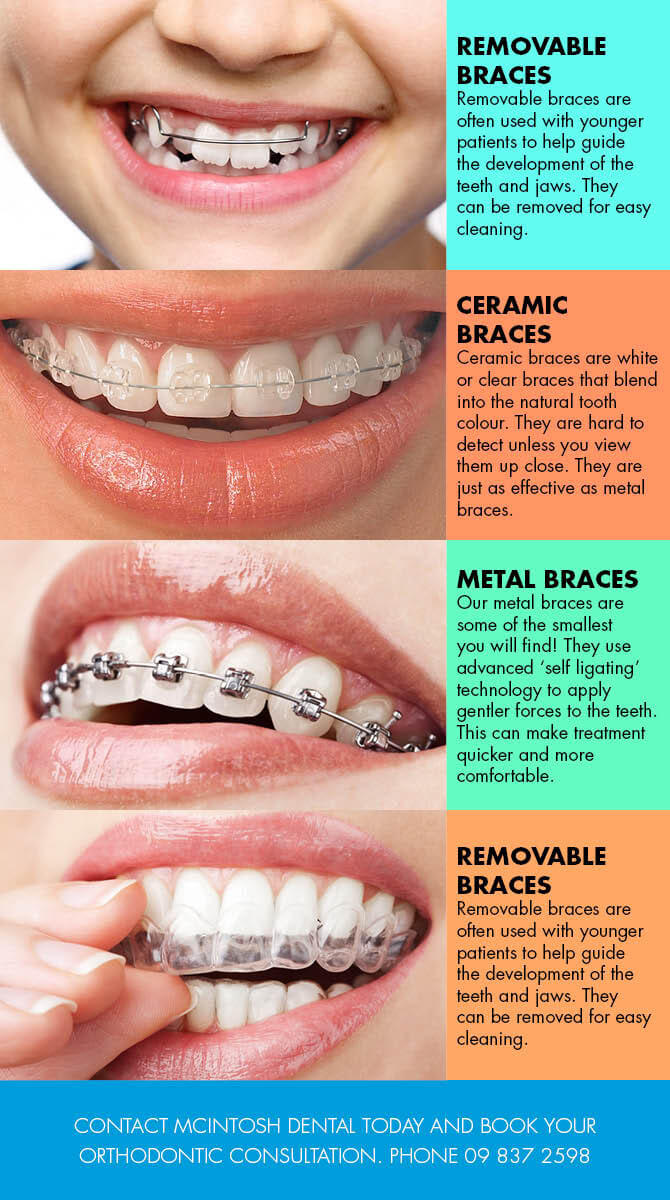 201707 Type of braces graphic Fraser Dental