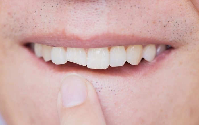 Dental emergency, chipped tooth