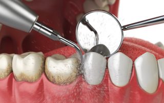 Teeth cleaning