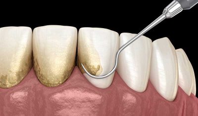 best treatment for gum disease