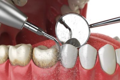 dentist teeth cleaning
