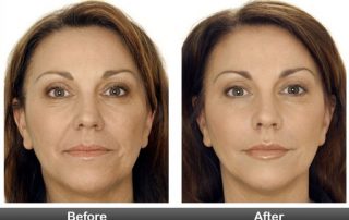 what to expect at your Botox appointment, Botox before and after