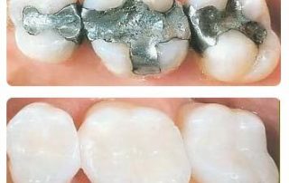 replace silver fillings