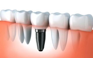 how long do dental implants last