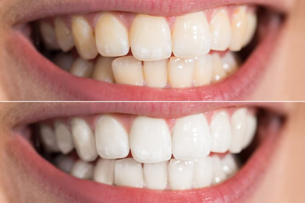 Teeth whitening, image of teeth before and after whitening