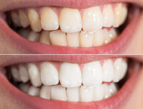 Teeth Whitening: Which Option Is Right For You?