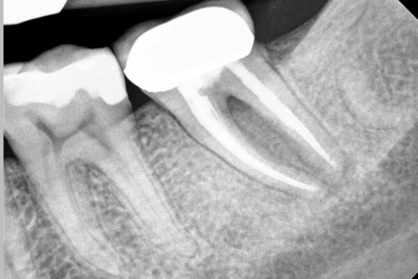 treatments-root-canal-feature root canal auckland