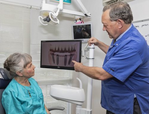 Questions You Should Ask Before Getting A Dental Implant