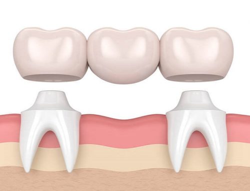 Dental Implants Versus Bridges