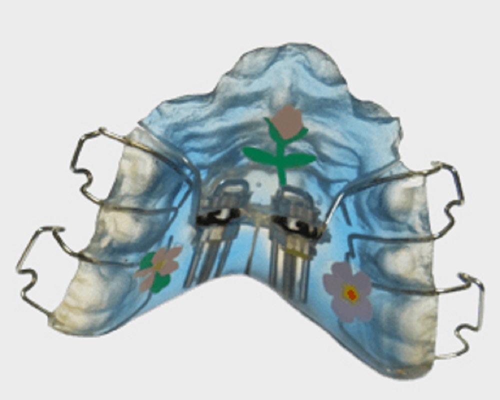 orthodontics-removable-appliance-post02 childrens orthodontics
