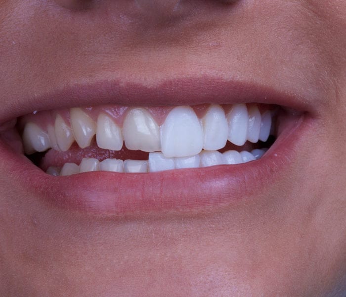 best veneers near me