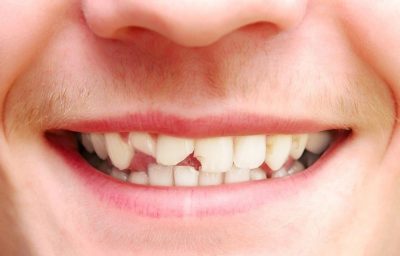 broken teeth treatment