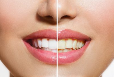 teeth whitening remove stains