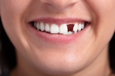 hobsonville dental implants