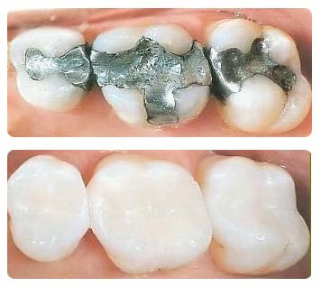 replace silver fillings