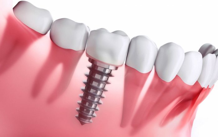tooth replacement options, dental implant