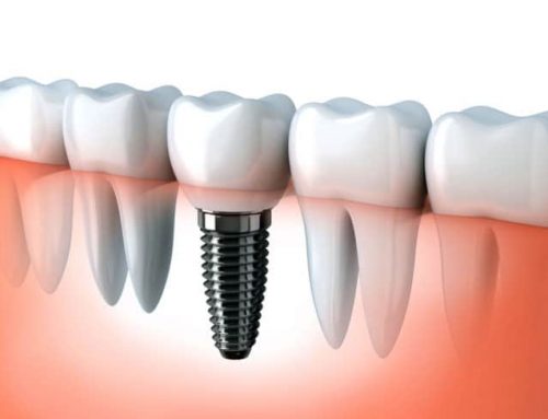 How Long Do Dental Implants Last For?